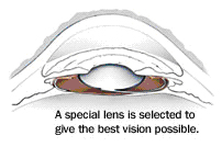 File:CataractSurgeryPic03.jpg